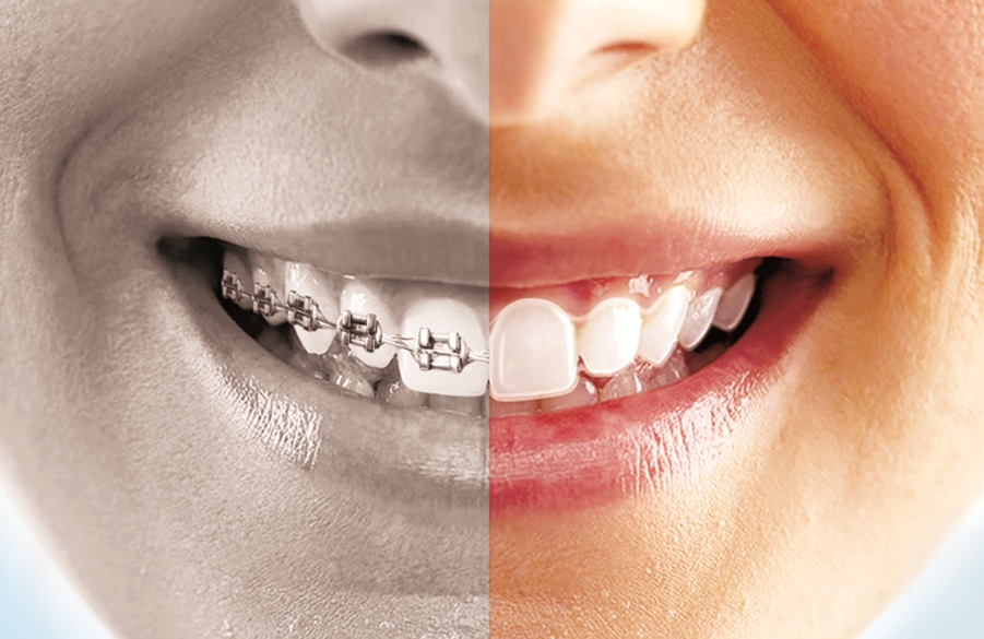 Image showing the difference between braces and 丽速齐's clear aligners.
